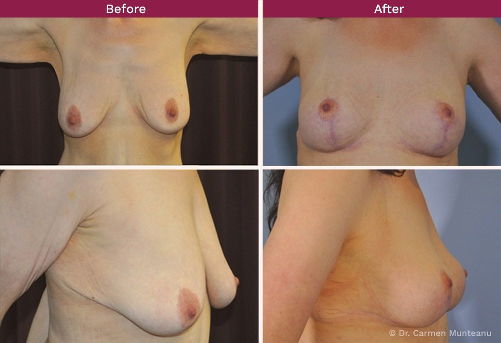 Breast Lift before and After Photos - Dr Carmen Munteanu Best Breast lift Surgeon Melbourne