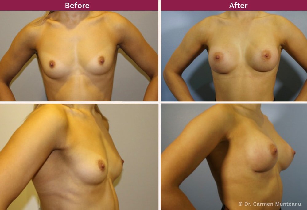 Breast Lift before and After Photos - Dr Carmen Munteanu Best Breast lift Surgeon Melbourne