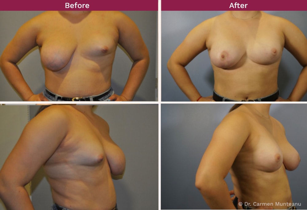 Breast Fat Transfer FAQs Asymmetry Before and After Photo