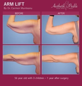 Arm lift FAQs Before and After Photos - Dr Carmen Munteanu - Best Arm Lift Surgeon Melbourne Victoria
