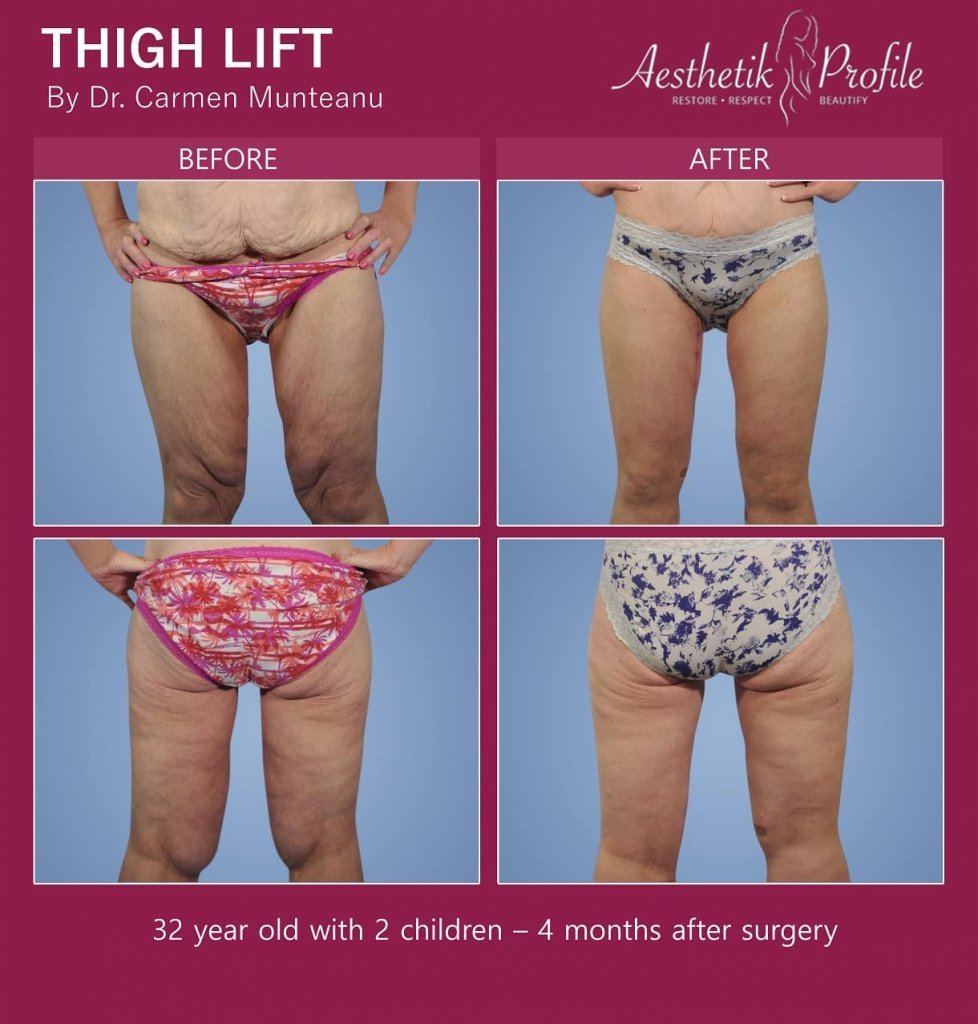 Thigh Lift Before and After Photos - Dr Carmen Munteanu - Best Thigh lift Surgeon Melbourne
