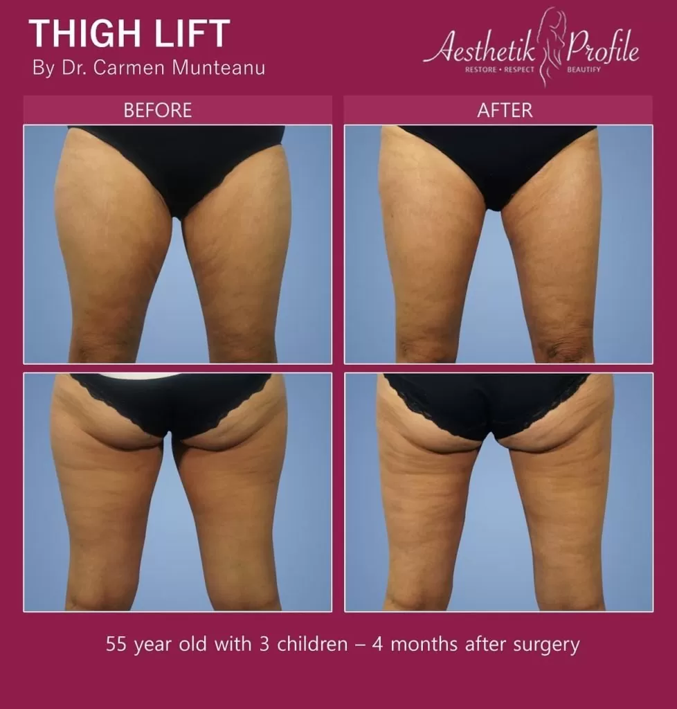 Thigh Lift Before and After Photos - Dr Carmen Munteanu - Best Thigh lift Surgeon Melbourne