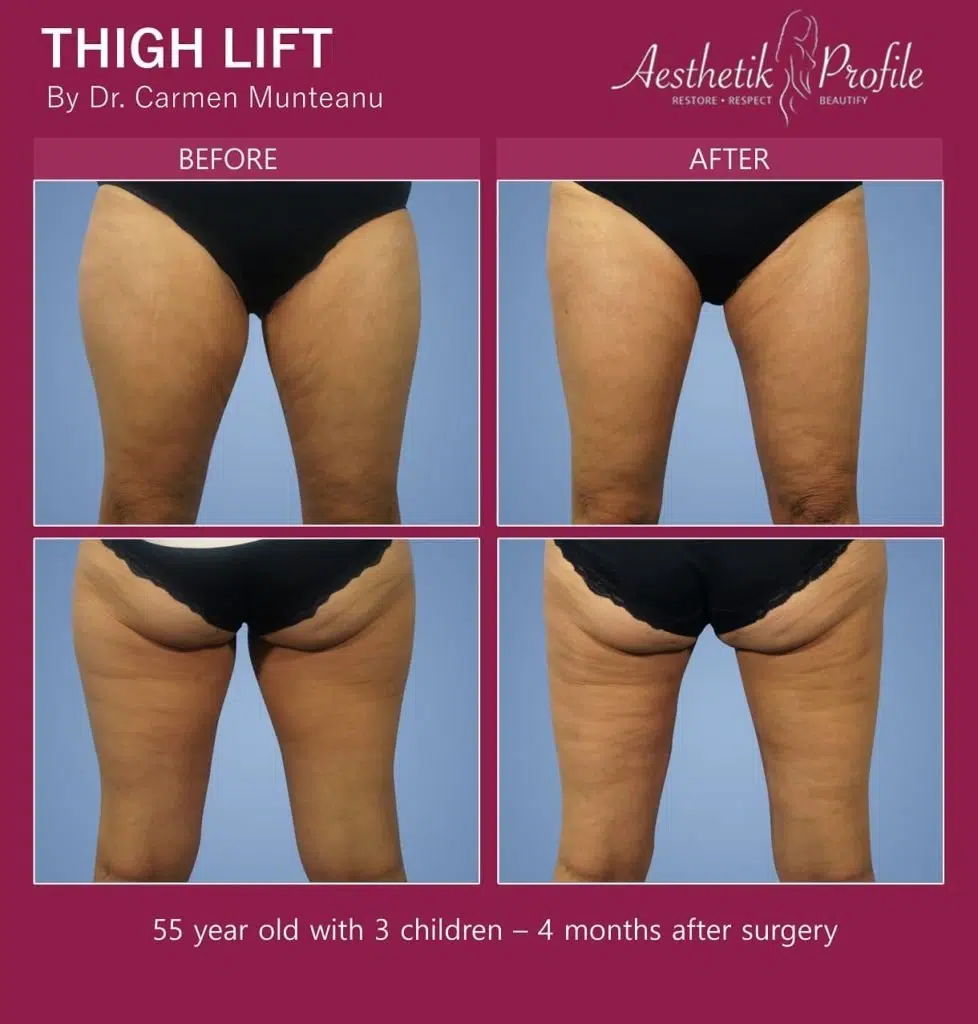 Mastering a Smooth Thigh Lift Surgery Recovery: Essential Steps