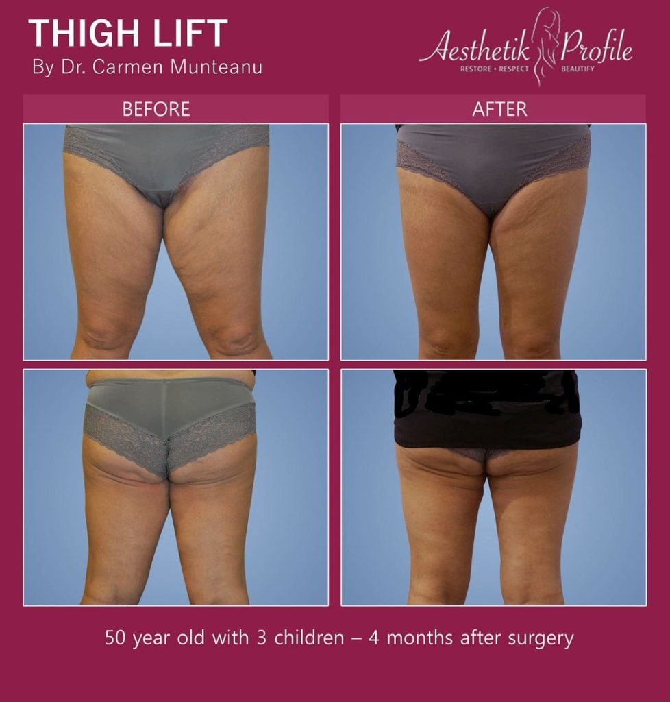 Thigh Lift Before and After Photos - Dr Carmen Munteanu - Best Thigh lift Surgeon Melbourne for Sagging Thighs