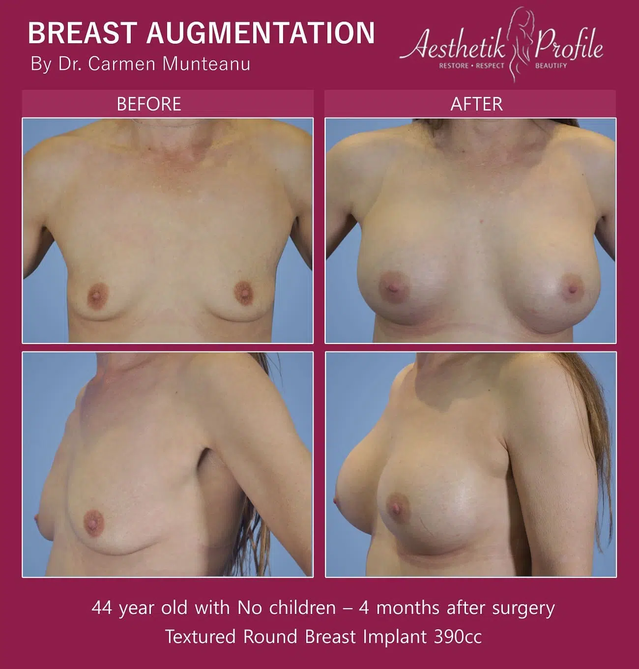 Breast Augmentation Before and After Photos - Boob Job Pics - Dr Carmen Munteanu Melbourne Plastic Surgeon