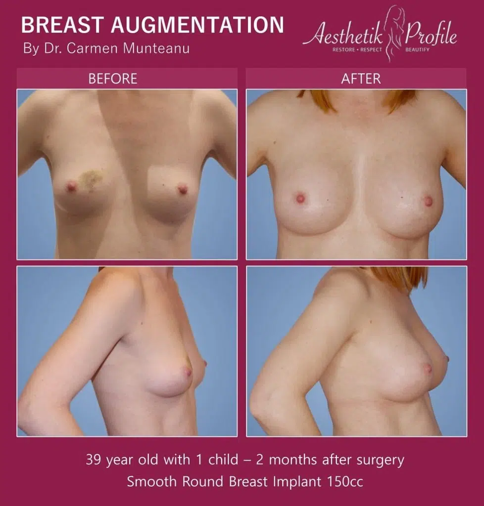 Breast Augmentation Before and After Photos - Boob Job Pics - Dr Carmen Munteanu Melbourne Plastic Surgeon