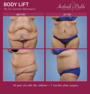Body Lift Before and After Photos - Dr Carmen Munteanu - Best Bodylift Surgeon Melbourne