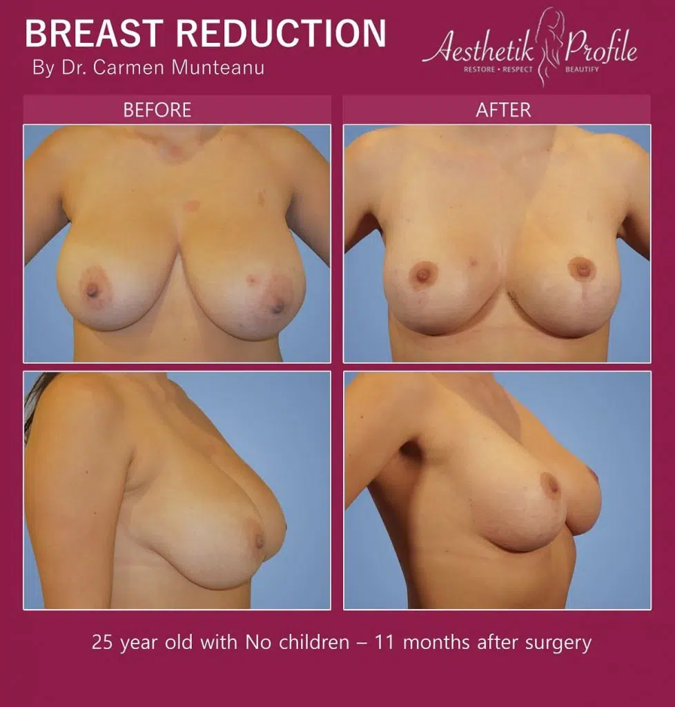Breast Reduction Before and After Photos - Dr Carmen Munteanu best breast reduction surgeon melbourne