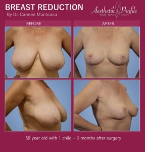 Breast Reduction FAQs Before and After Photos - Dr Carmen Munteanu best breast reduction surgeon melbourne