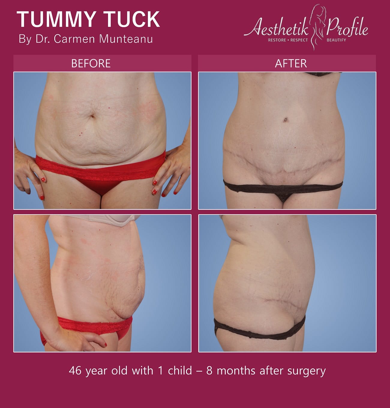 Tummy Tuck Before and After Photos - Dr Carmen Munteanu - Best Tummy Tuck Surgeon Melbourne