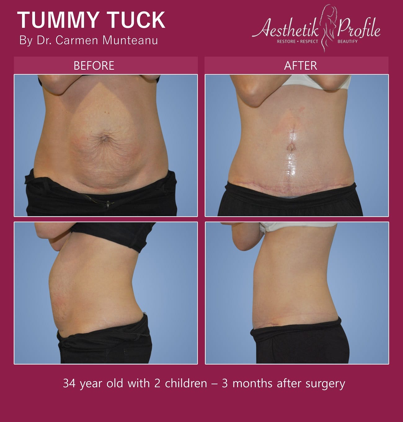 Fleur De lis FDL Abdominoplasty Before and After Photos - Dr Carmen Munteanu - Best Tummy Tuck Surgeon Melbourne