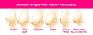 Carmen Munteanu Plastic Surgeon Cosmetic Blog - Breast Ptosis