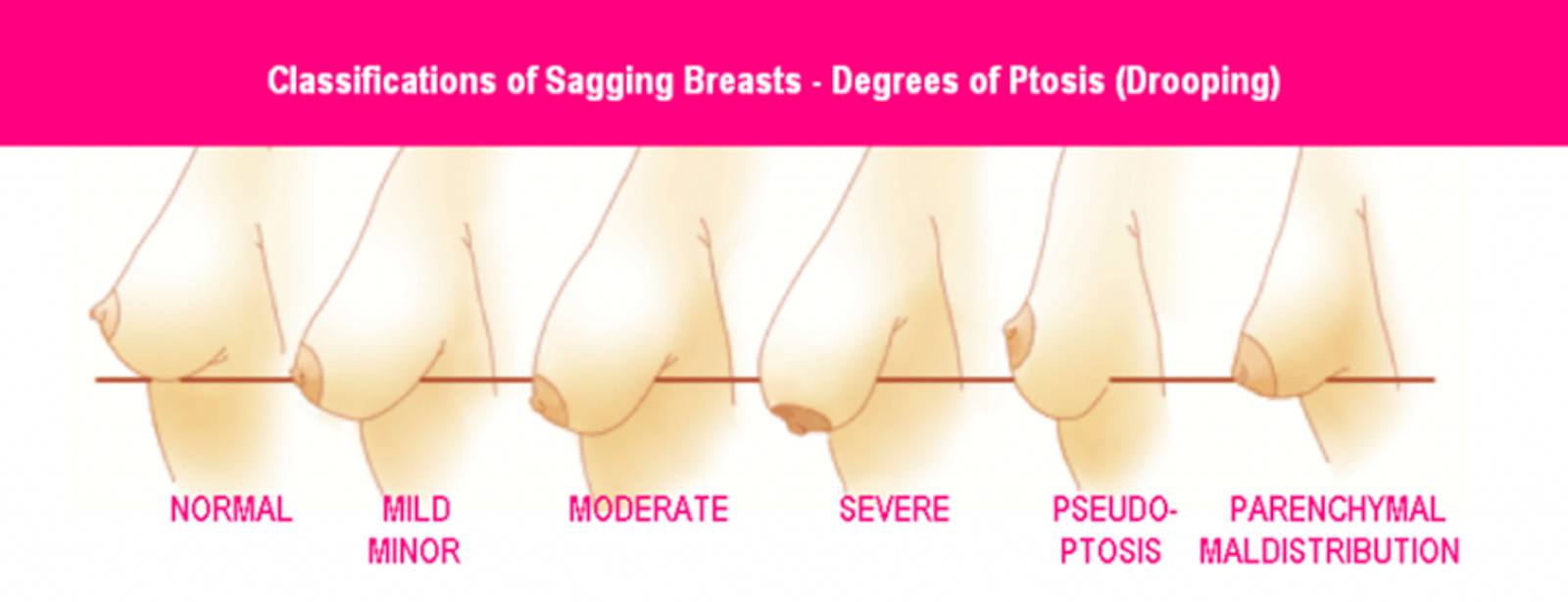 Carmen Munteanu Plastic Surgeon Cosmetic Blog - Solutions for Sagging Dropping Breasts Image of Classifications of Ptosis