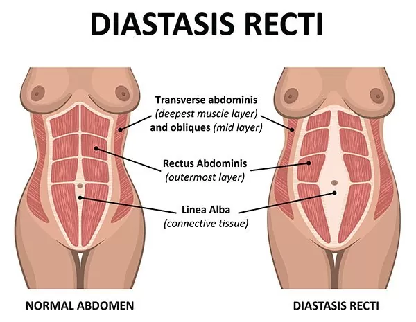 diastasis recti split tummy muscles