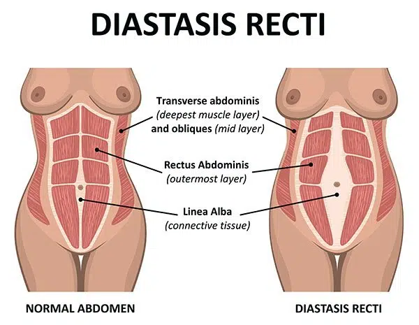 Diastasis Recti Surgery Repairing Abdominal Muscles Dr Carmen