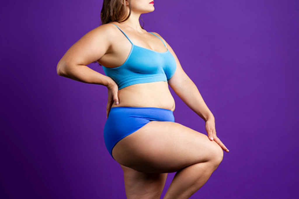 Is Thigh Lift Surgery Effective Blog on Carmen Munteanu Plastic Surgeon - Fat Woman in Two Piece