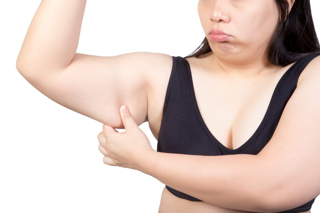 Arm Lift FAQs - Dr Carmen Munteanu Blog on Recovery and Rest after Arm Lift Surgery - Woman Holding Her Upper Arm Fats