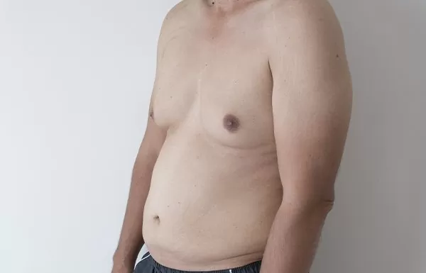 Male-Breast-Reduction