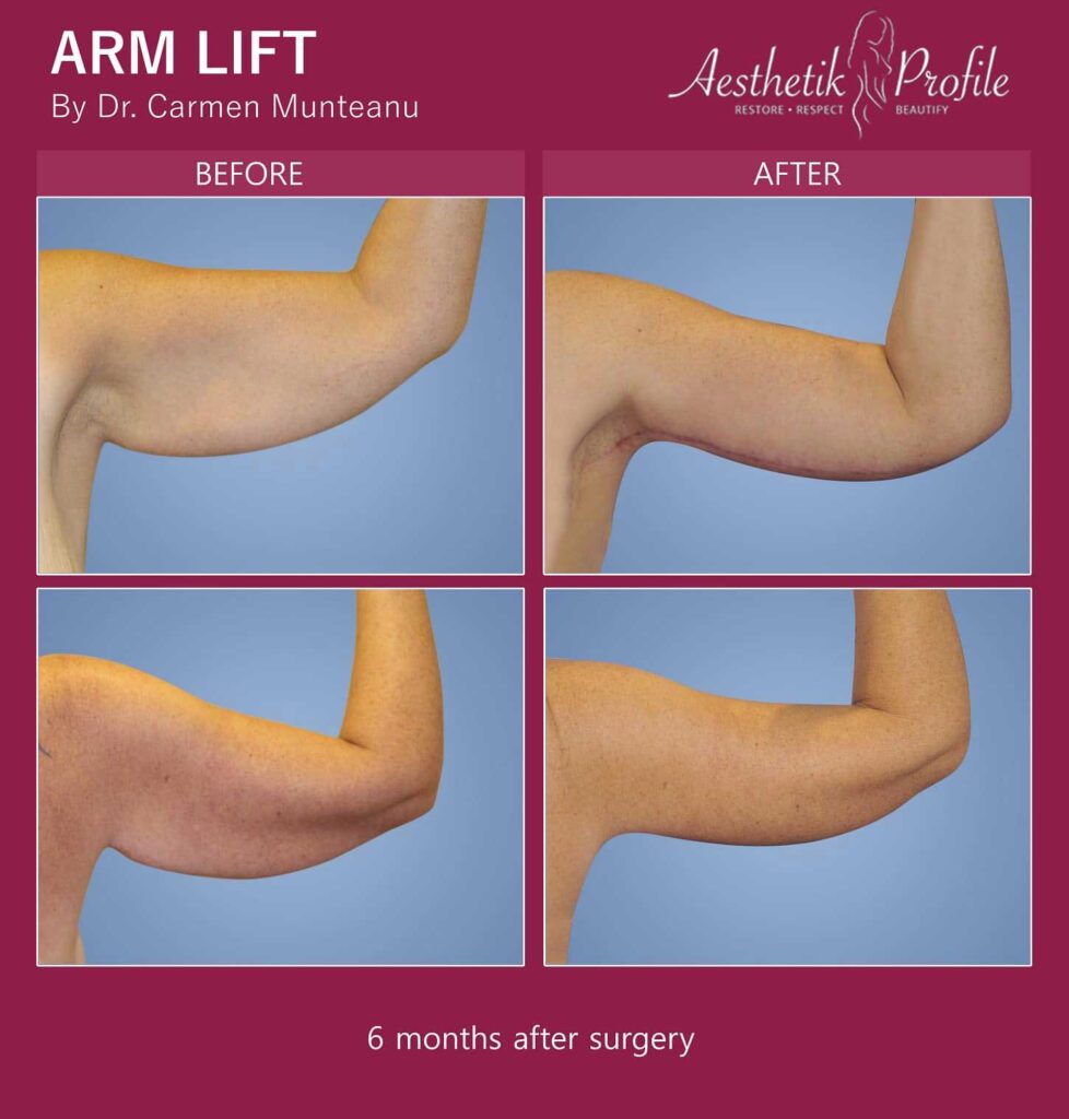 Scars after Arm Lift Surgery