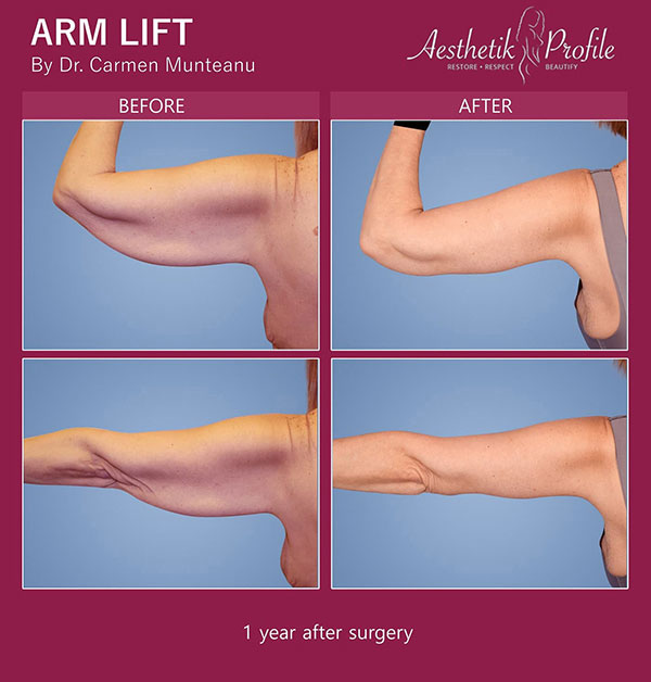 Arm lift Surgery by Dr Carmen Munteanu Brachioplasty Surgery