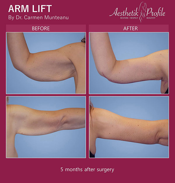 Arm Lift Surgery