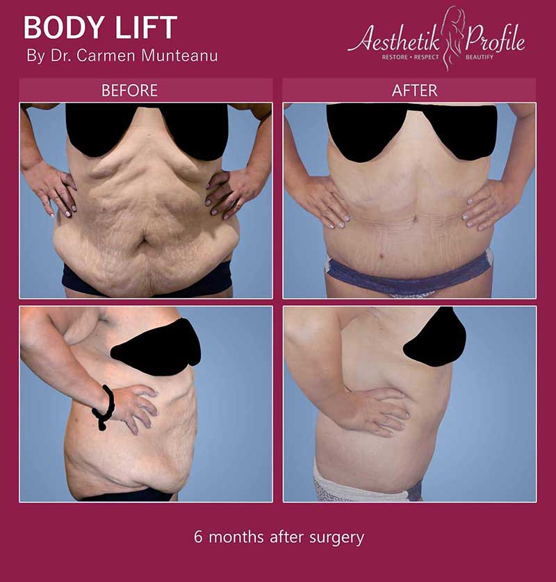 Body Lift Before & After Gallery: Patient 4