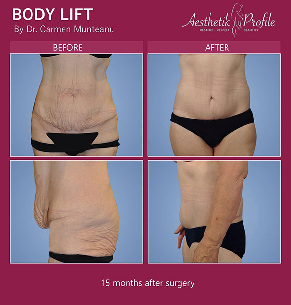 Bodylift-Before-and-after-Melbourne-1
