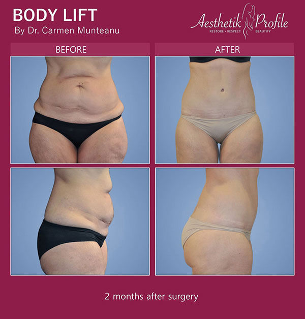 Bodylift-Before-and-after-Melbourne