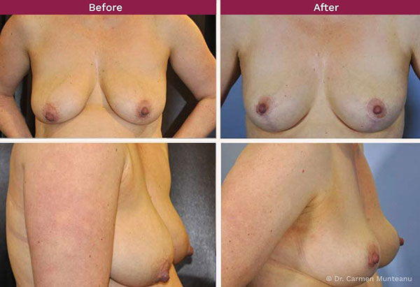 Breast-Lift-Before-and-after-Melbourne-2