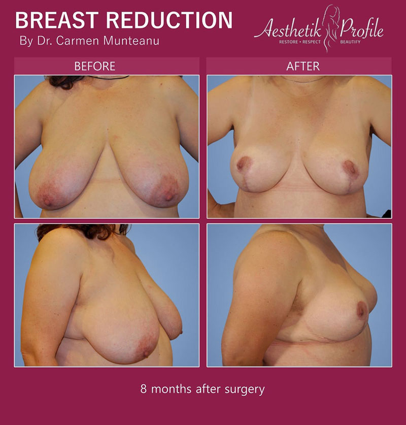 Breast-Reduction-Before-and-After-Photos---Dr-Carmen-Munteanu-best-breast-reduction-surgeon-melbourne-16