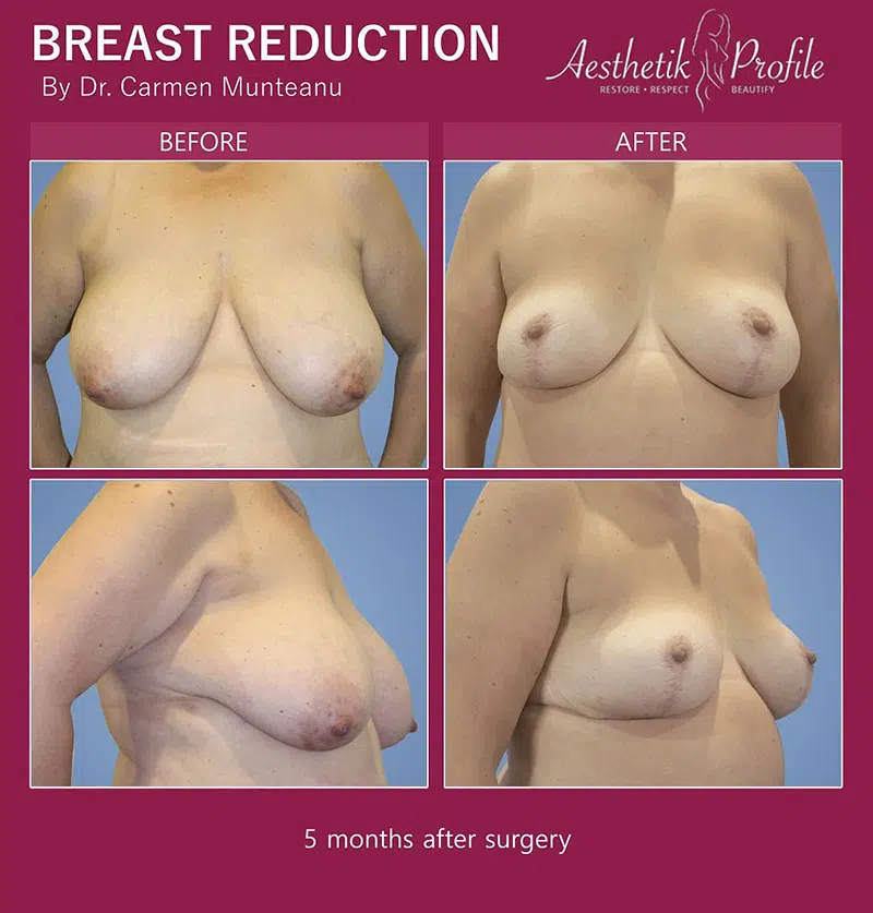 Breast Reduction