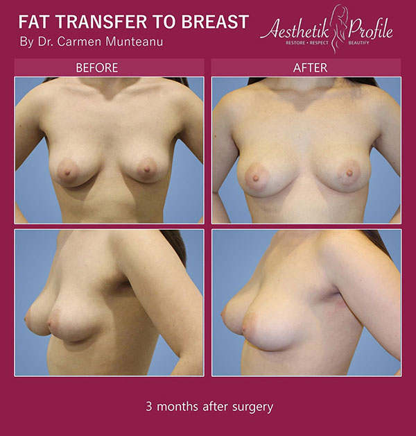 Fat Transfer to the Breasts Results