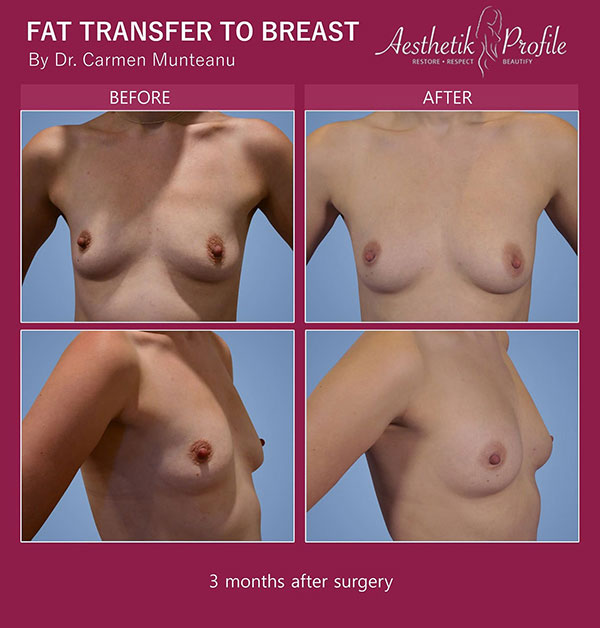 Fat-transfer-to-breast--Before-and-after-Melbourne