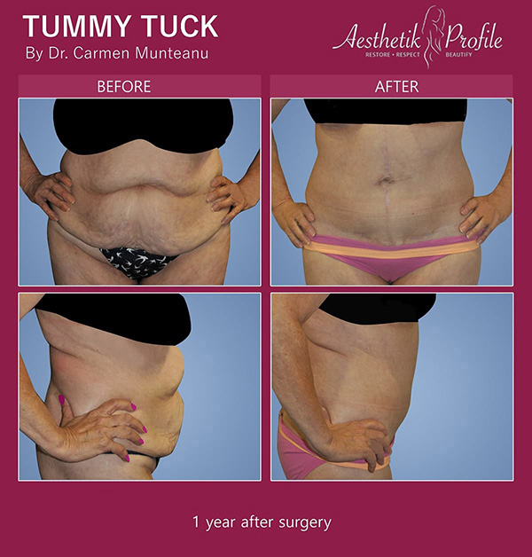 Fleur De Lis Abdominoplasty Melbourne Dr Carmen Munteanu