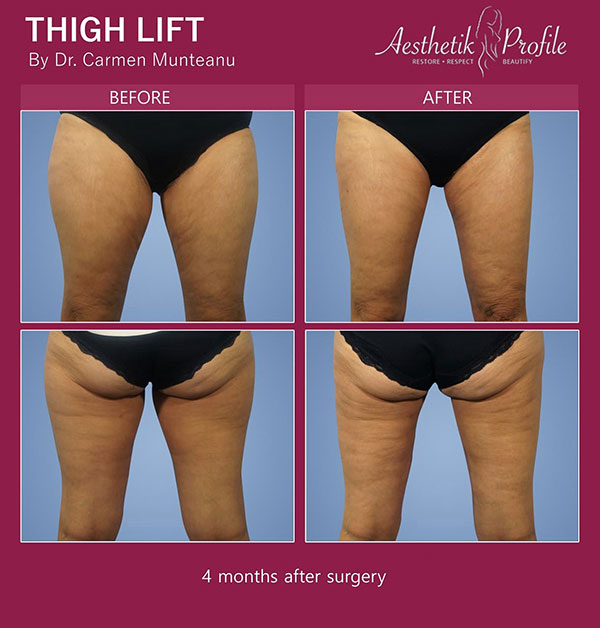 Thigh Lift NYC, Inner Thigh Surgery