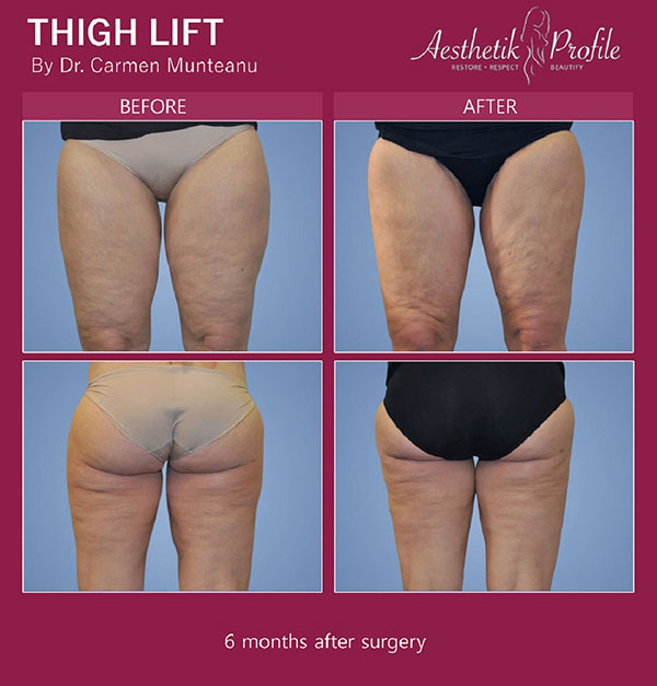 Thighlift-Surgery-Before-And-After-Photos Melbourne