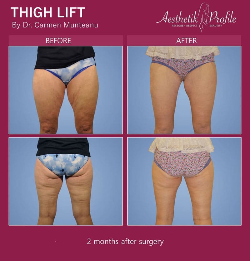 Thigh Lift Before and After Photos - Dr Carmen Munteanu