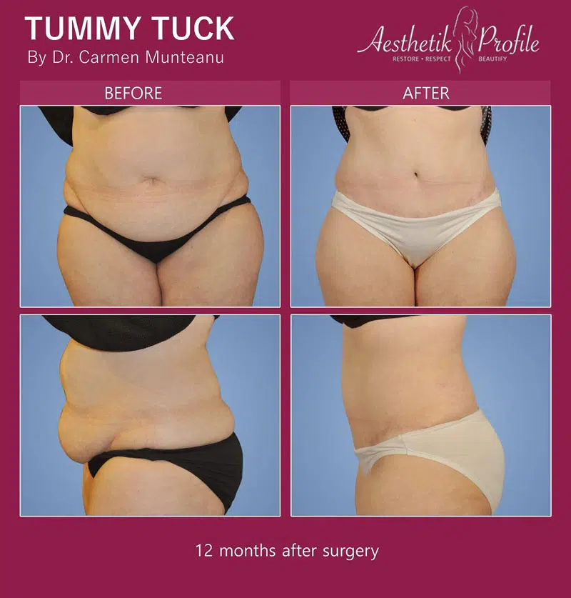 abdominoplasty