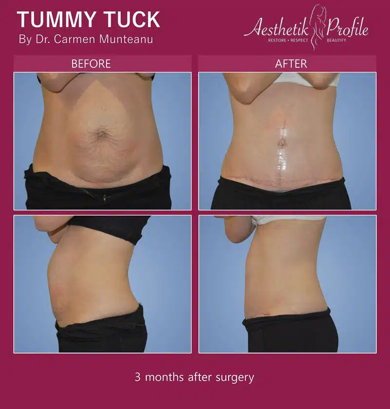 abdominoplasty - muscle separation