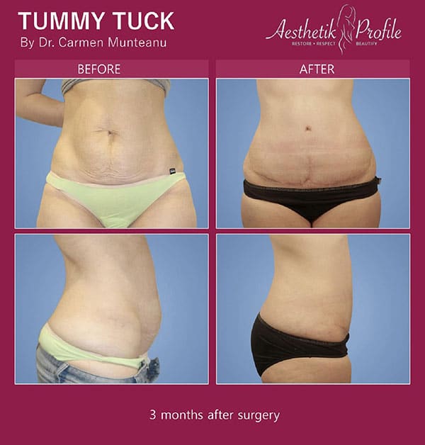 Tummy Tuck FAQs - Abdominoplasty Frequently Asked Questions