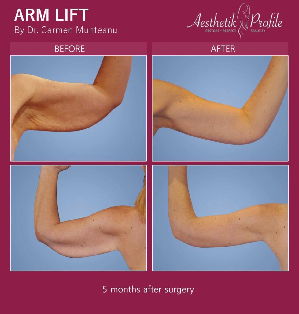 _Arm-Lift-Before-and-after-Melbourne-7