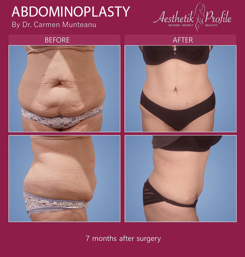 abdominoplasty-tummy-tuck-Before-and-after-Melbourne-10
