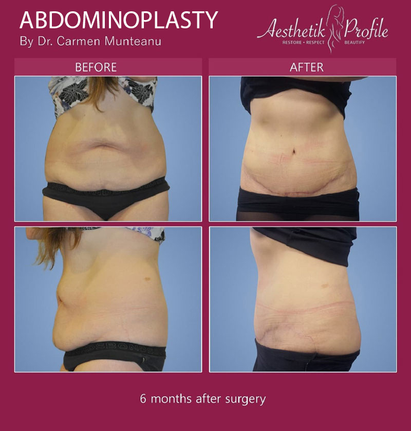 Medico offers Surgical Garments and Aids for after Abdominoplasty Surgery