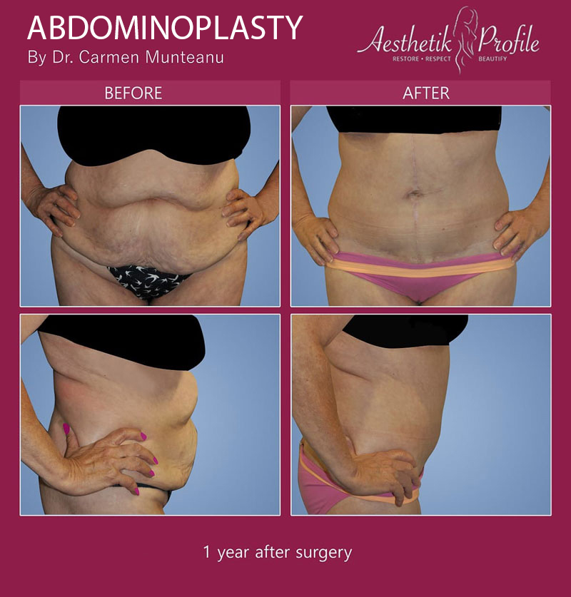 Compression Garments after Abdominoplasty - Dr Carmen Munteanu