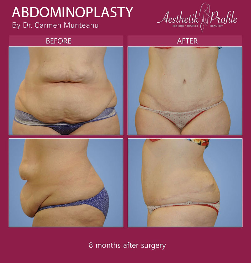Tummy Tuck Before and After Photos - Dr Carmen Munteanu