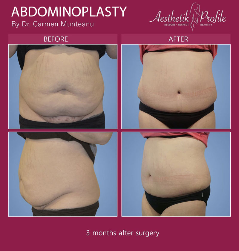 Tummy Tuck (Abdominoplasty) Before and After Photos - Dr Anzarut