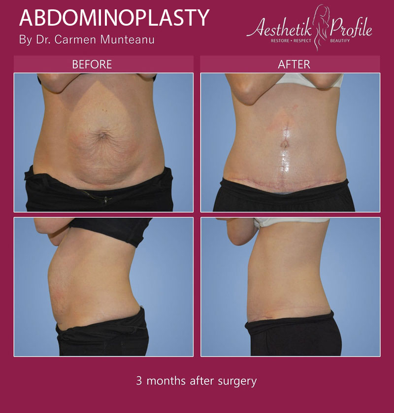 6 Recovery Recovery after Abdominoplasty – Timeline and Tips