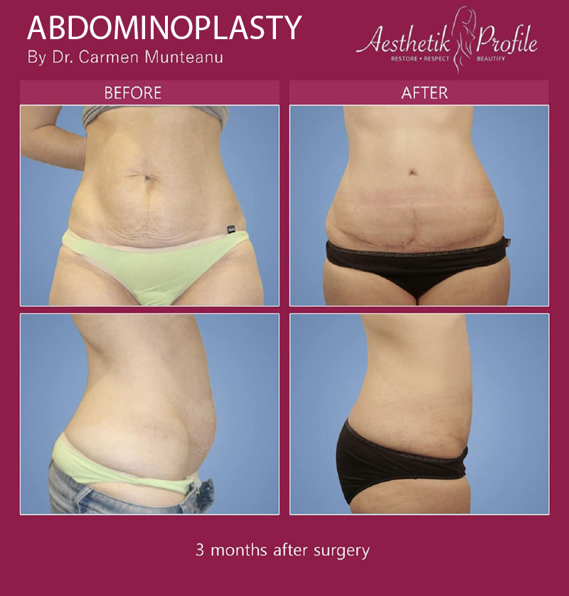 abdominoplasty-tummy-tuck-Before-and-after-Melbourne-7