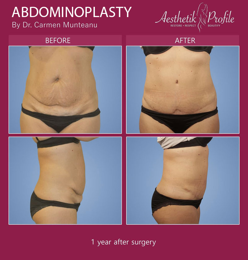 Tummy Tuck Before and After Photos - Dr Carmen Munteanu