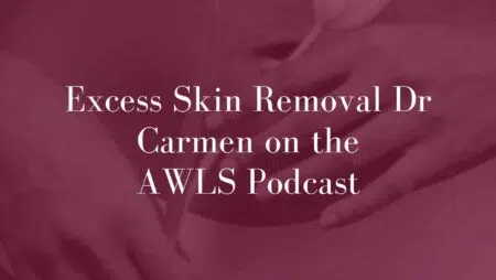 Excess-Skin-Removal-Dr-Carmen-on-the-AWLS-Podcast